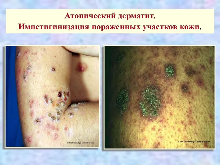Атопический дерматит. Импетигинизация пораженных участков кожи.