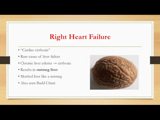 Right Heart Failure • “Cardiac cirrhosis” • Rare cause of liver failure