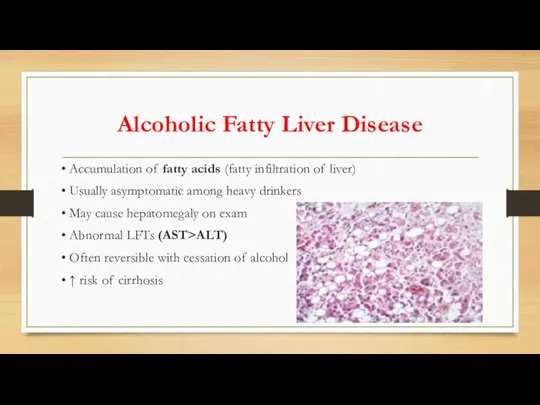 Alcoholic Fatty Liver Disease • Accumulation of fatty acids (fatty infiltration of