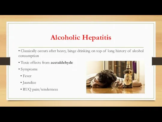 Alcoholic Hepatitis • Classically occurs after heavy, binge drinking on top of