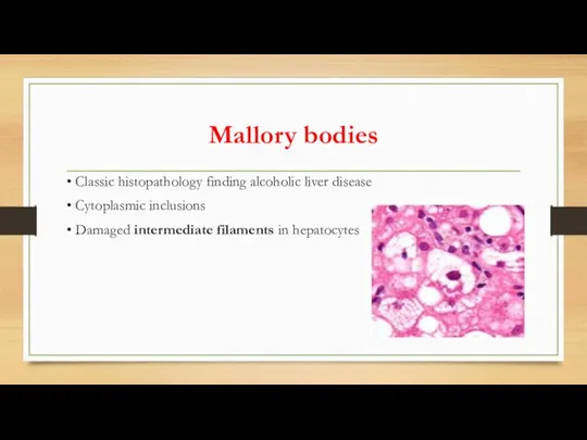 Mallory bodies • Classic histopathology finding alcoholic liver disease • Cytoplasmic inclusions