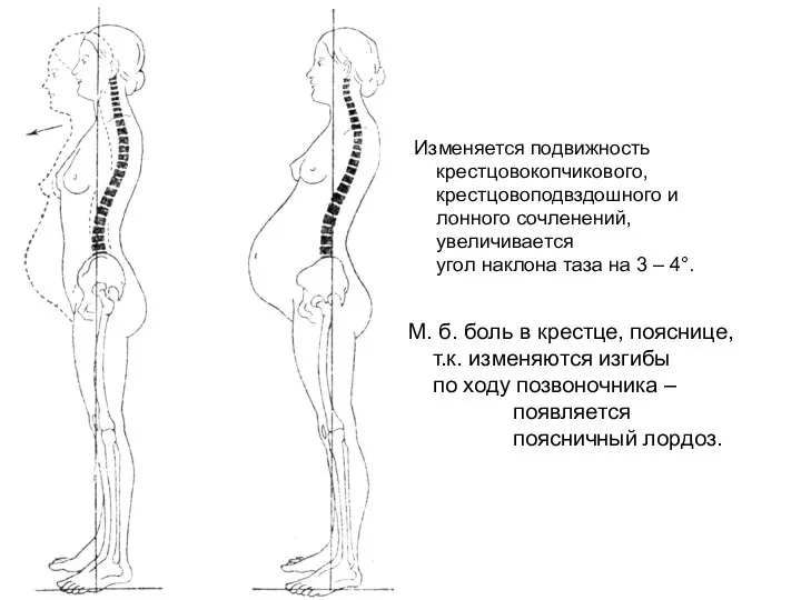 М. б. боль в крестце, пояснице, т.к. изменяются изгибы по ходу позвоночника