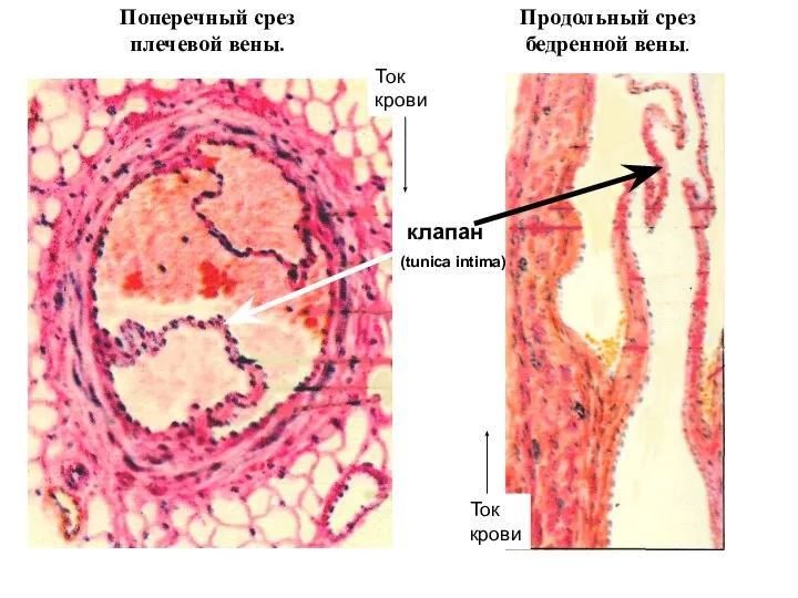 Поперечный срез плечевой вены. Продольный срез бедренной вены. клапан (tunica intima) Ток крови Ток крови