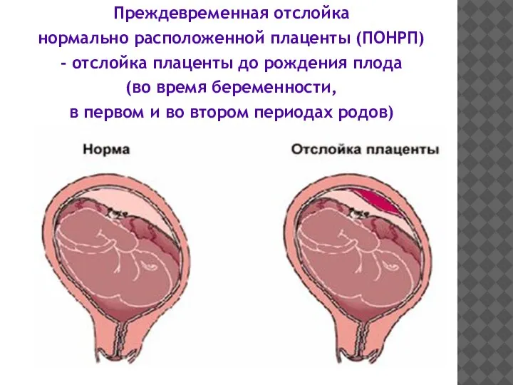 Преждевременная отслойка нормально расположенной плаценты (ПОНРП) - отслойка плаценты до рождения плода