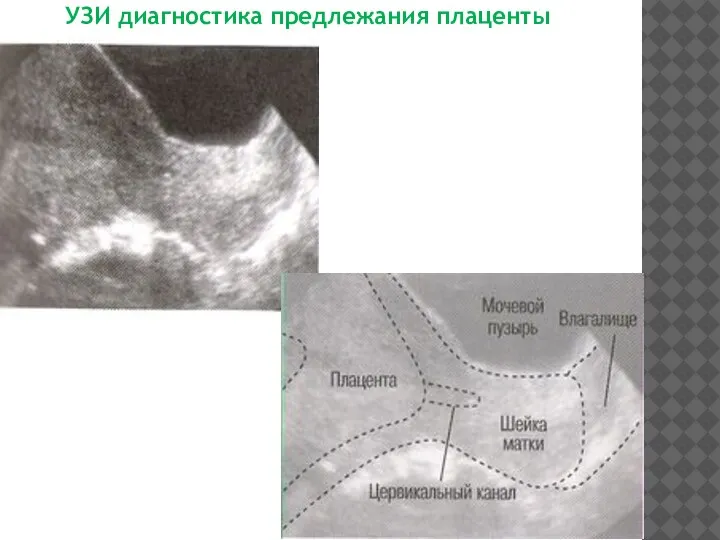 УЗИ диагностика предлежания плаценты