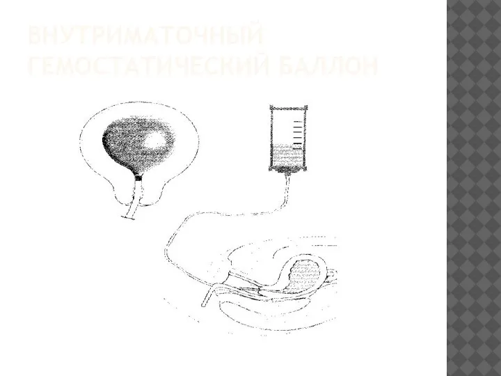 ВНУТРИМАТОЧНЫЙ ГЕМОСТАТИЧЕСКИЙ БАЛЛОН