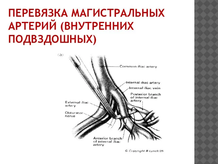 ПЕРЕВЯЗКА МАГИСТРАЛЬНЫХ АРТЕРИЙ (ВНУТРЕННИХ ПОДВЗДОШНЫХ)