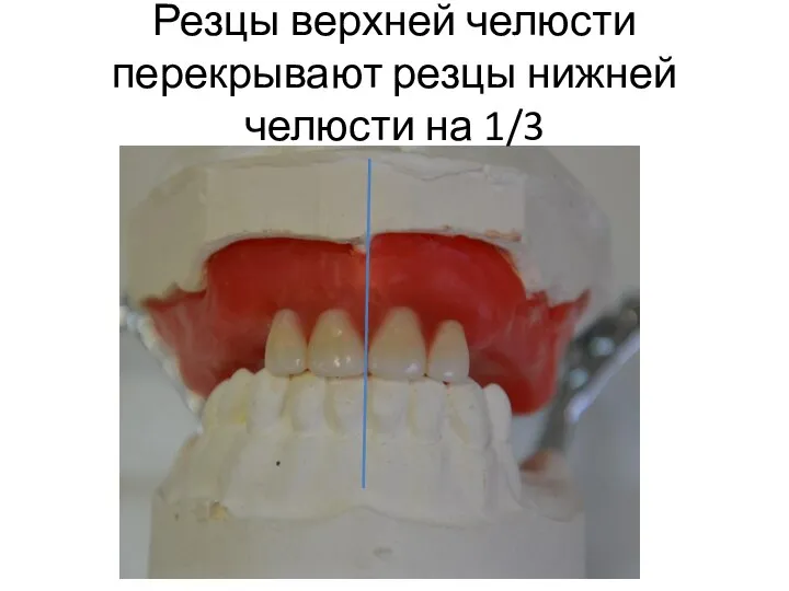 Резцы верхней челюсти перекрывают резцы нижней челюсти на 1/3