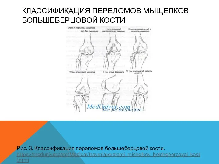 КЛАССИФИКАЦИЯ ПЕРЕЛОМОВ МЫЩЕЛКОВ БОЛЬШЕБЕРЦОВОЙ КОСТИ Рис. 3. Классификация переломов большеберцовой кости. https://meduniver.com/Medical/travmi/perelomi_michelkov_bolshebercovoi_kosti.html