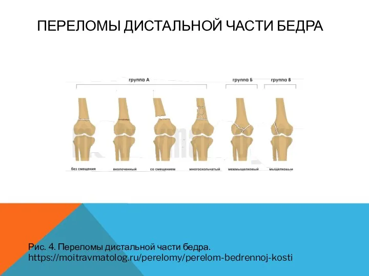 ПЕРЕЛОМЫ ДИСТАЛЬНОЙ ЧАСТИ БЕДРА Рис. 4. Переломы дистальной части бедра. https://moitravmatolog.ru/perelomy/perelom-bedrennoj-kosti