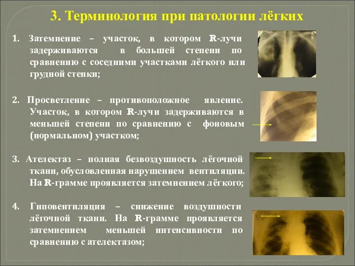 3. Терминология при патологии лёгких 1. Затемнение – участок, в котором R-лучи