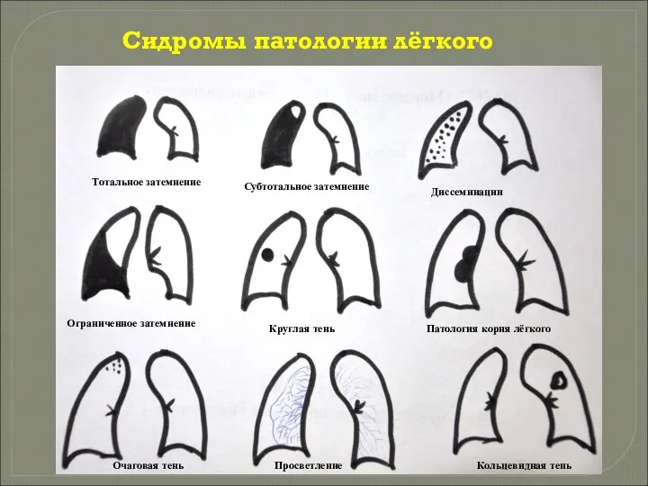 Сидромы патологии лёгкого е Тотальное затемнение Субтотальное затемнение Диссеминации Ограниченное затемнение Круглая