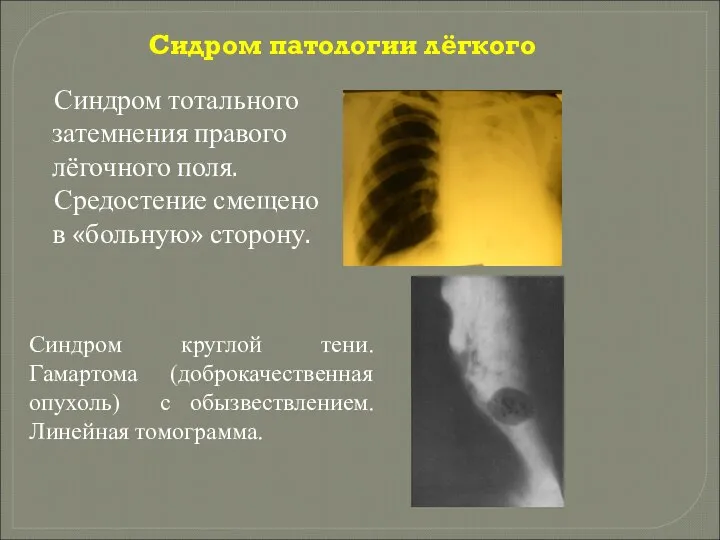 Сидром патологии лёгкого Синдром тотального затемнения правого лёгочного поля. Средостение смещено в