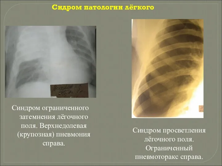 Сидром патологии лёгкого Синдром ограниченного затемнения лёгочного поля. Верхнедолевая (крупозная) пневмония справа.