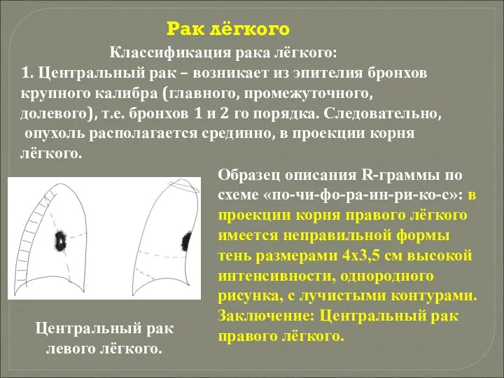 Рак лёгкого Классификация рака лёгкого: 1. Центральный рак – возникает из эпителия