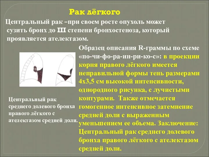 Рак лёгкого Центральный рак –при своем росте опухоль может сузить бронх до