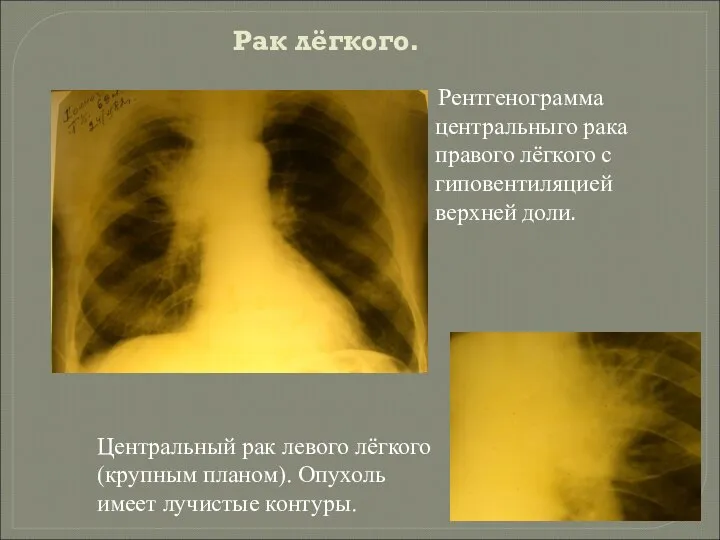 Рак лёгкого. Рентгенограмма центральныго рака правого лёгкого с гиповентиляцией верхней доли. Центральный