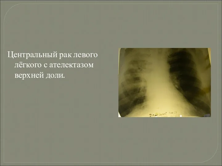Центральный рак левого лёгкого с ателектазом верхней доли.