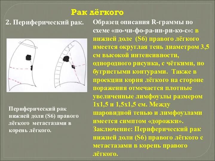 Рак лёгкого 2. Периферический рак. Периферический рак нижней доли (S6) правого лёгкого