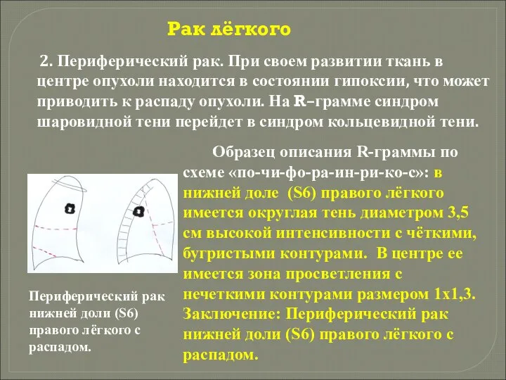 Рак лёгкого 2. Периферический рак. При своем развитии ткань в центре опухоли