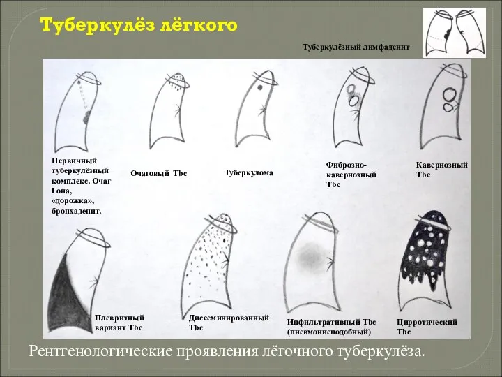 Туберкулёз лёгкого Рентгенологические проявления лёгочного туберкулёза. Первичный туберкулёзный комплекс. Очаг Гона, «дорожка»,