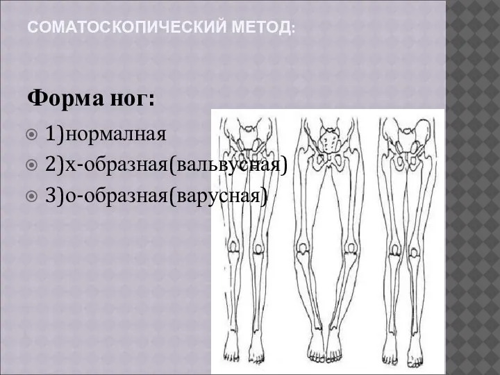 СОМАТОСКОПИЧЕСКИЙ МЕТОД: Форма ног: 1)нормалная 2)х-образная(вальвусная) 3)о-образная(варусная)