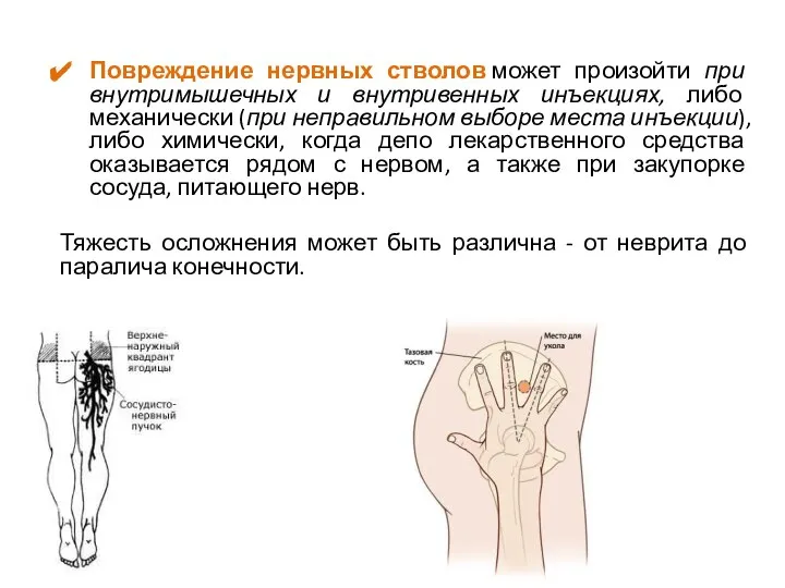 Повреждение нервных стволов может произойти при внутримышечных и внутривенных инъекциях, либо механически