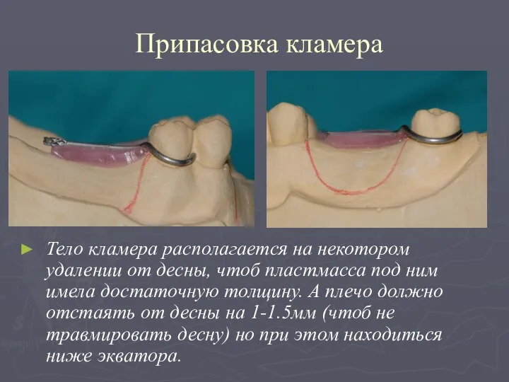 Припасовка кламера Тело кламера располагается на некотором удалении от десны, чтоб пластмасса