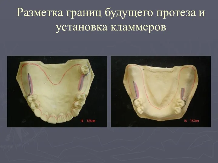 Разметка границ будущего протеза и установка кламмеров