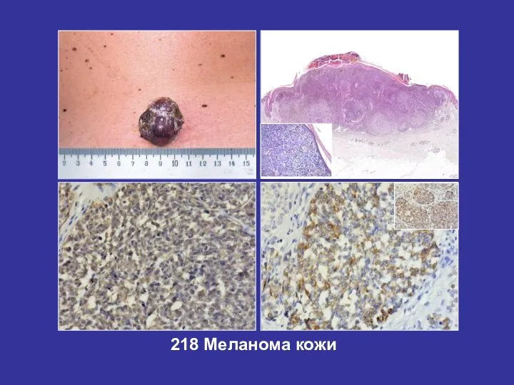 218 Меланома кожи