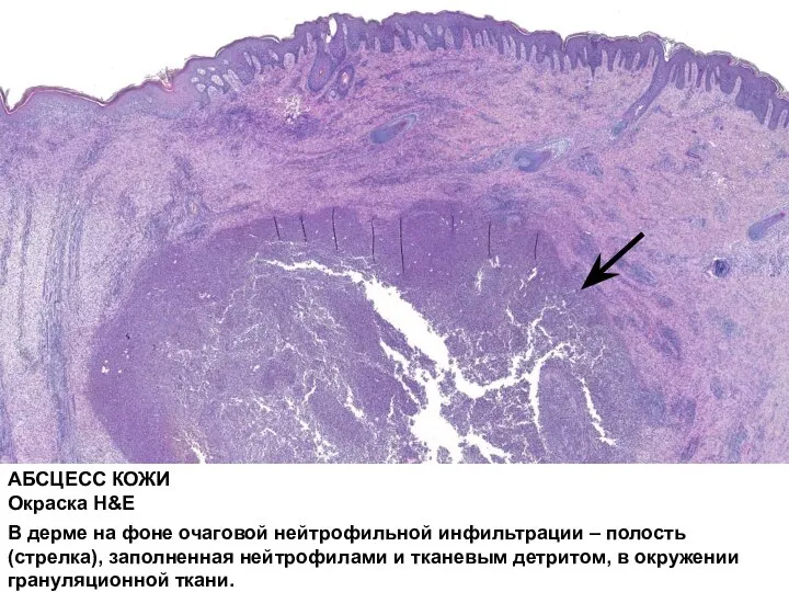 АБСЦЕСС КОЖИ Окраска H&E В дерме на фоне очаговой нейтрофильной инфильтрации –