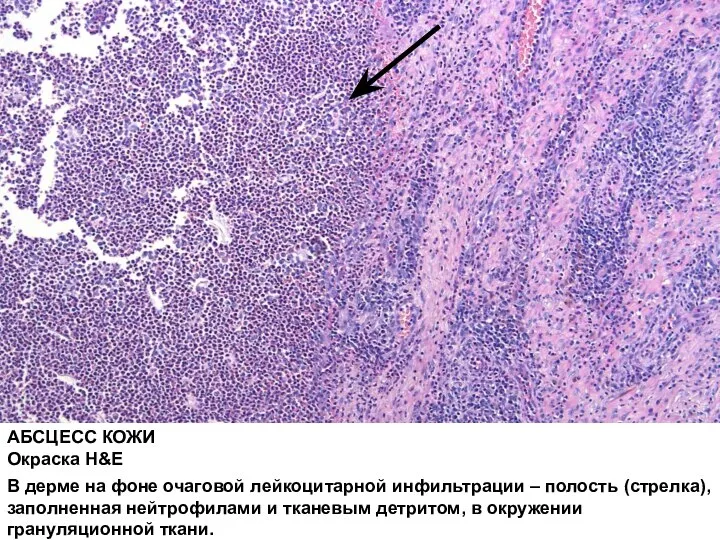 АБСЦЕСС КОЖИ Окраска H&E В дерме на фоне очаговой лейкоцитарной инфильтрации –