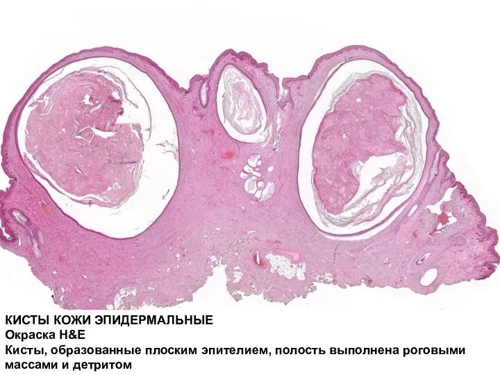 КИСТЫ КОЖИ ЭПИДЕРМАЛЬНЫЕ Окраска H&E Кисты, образованные плоским эпителием, полость выполнена роговыми массами и детритом