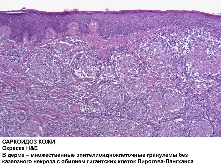 САРКОИДОЗ КОЖИ Окраска H&E В дерме – множественные эпителиоидноклеточные гранулемы без казеозного