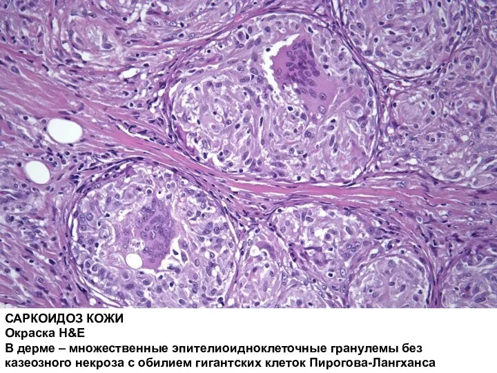 САРКОИДОЗ КОЖИ Окраска H&E В дерме – множественные эпителиоидноклеточные гранулемы без казеозного