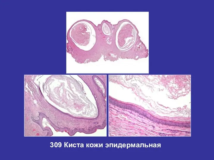 309 Киста кожи эпидермальная