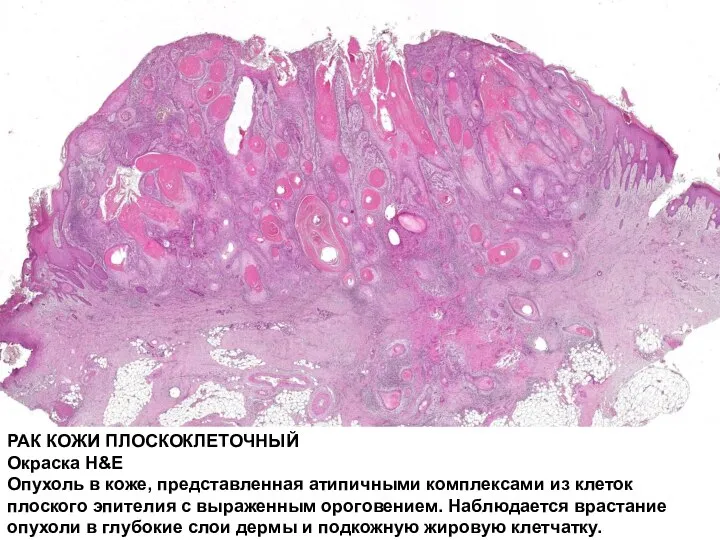 РАК КОЖИ ПЛОСКОКЛЕТОЧНЫЙ Окраска H&E Опухоль в коже, представленная атипичными комплексами из