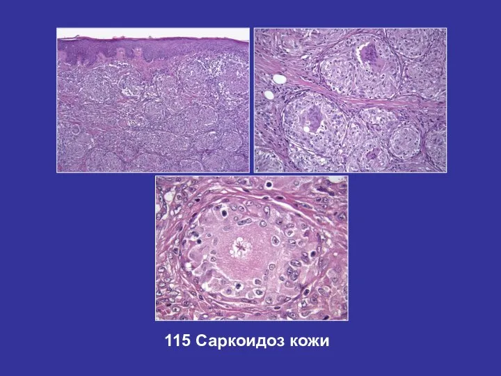 115 Саркоидоз кожи