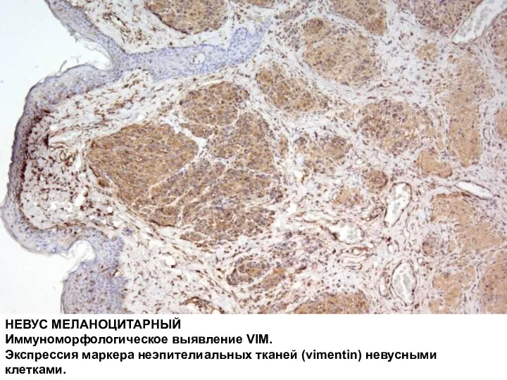 НЕВУС МЕЛАНОЦИТАРНЫЙ Иммуноморфологическое выявление VIM. Экспрессия маркера неэпителиальных тканей (vimentin) невусными клетками.