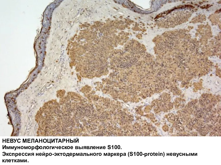 НЕВУС МЕЛАНОЦИТАРНЫЙ Иммуноморфологическое выявление S100. Экспрессия нейро-эктодермального маркера (S100-protein) невусными клетками.