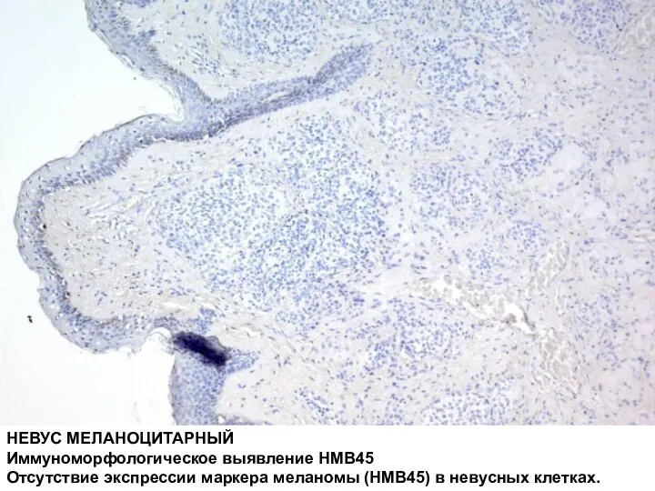 НЕВУС МЕЛАНОЦИТАРНЫЙ Иммуноморфологическое выявление HMB45 Отсутствие экспрессии маркера меланомы (HMB45) в невусных клетках.