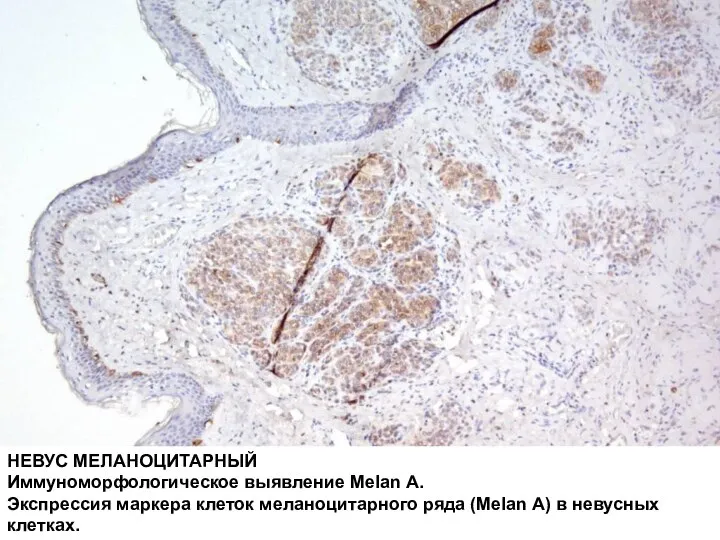 НЕВУС МЕЛАНОЦИТАРНЫЙ Иммуноморфологическое выявление Melan A. Экспрессия маркера клеток меланоцитарного ряда (Melan A) в невусных клетках.