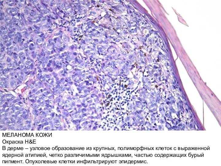 МЕЛАНОМА КОЖИ Окраска H&E В дерме – узловое образование из крупных, полиморфных