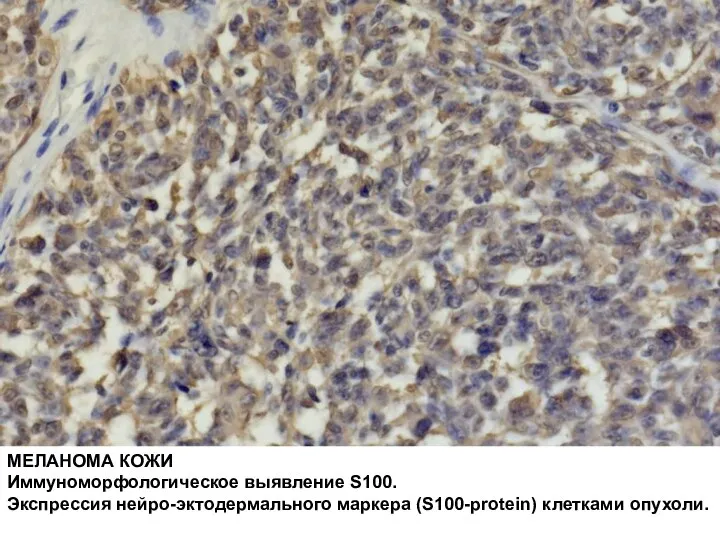 МЕЛАНОМА КОЖИ Иммуноморфологическое выявление S100. Экспрессия нейро-эктодермального маркера (S100-protein) клетками опухоли.