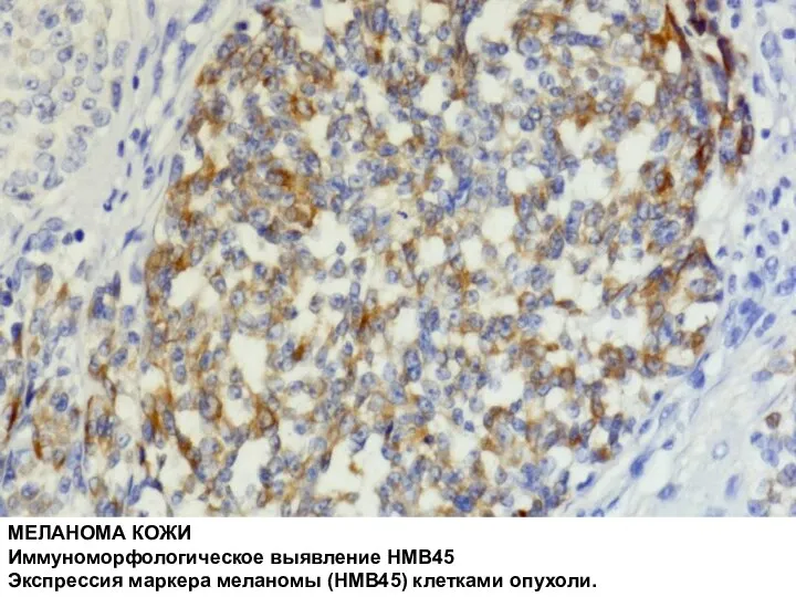 МЕЛАНОМА КОЖИ Иммуноморфологическое выявление HMB45 Экспрессия маркера меланомы (HMB45) клетками опухоли.