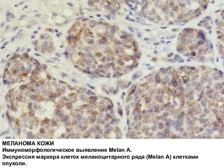 МЕЛАНОМА КОЖИ Иммуноморфологическое выявление Melan A. Экспрессия маркера клеток меланоцитарного ряда (Melan A) клетками опухоли.