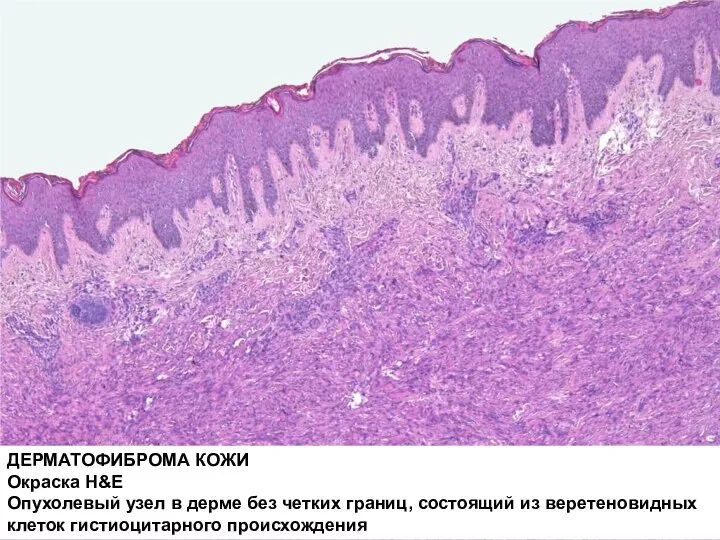 ДЕРМАТОФИБРОМА КОЖИ Окраска H&E Опухолевый узел в дерме без четких границ, состоящий