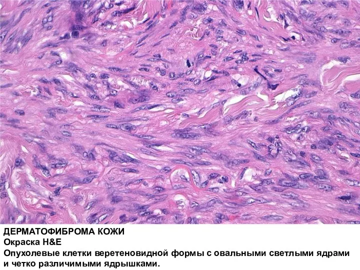ДЕРМАТОФИБРОМА КОЖИ Окраска H&E Опухолевые клетки веретеновидной формы с овальными светлыми ядрами и четко различимыми ядрышками.