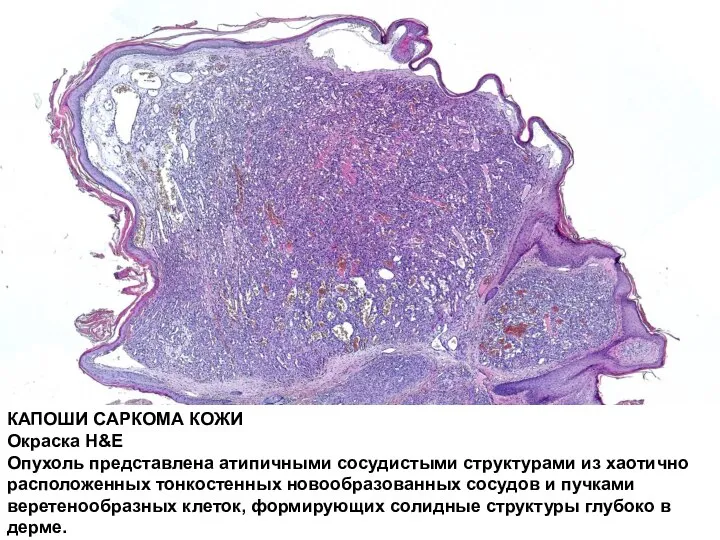 КАПОШИ САРКОМА КОЖИ Окраска H&E Опухоль представлена атипичными сосудистыми структурами из хаотично