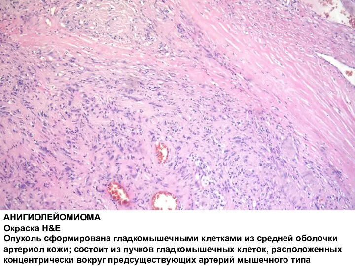 АНИГИОЛЕЙОМИОМА Окраска H&E Опухоль сформирована гладкомышечными клетками из средней оболочки артериол кожи;